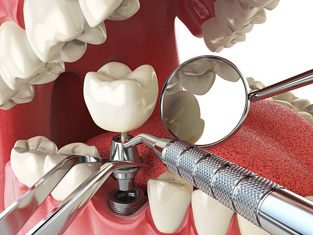 Best Emergency Tooth Extraction in Maywood, IL